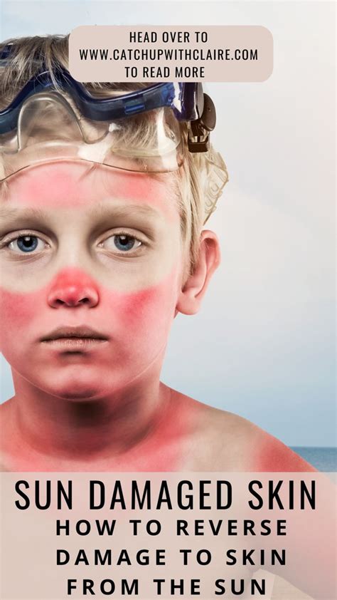 sunburn weeping|Sunburn and Other Sun Reactions of the Skin